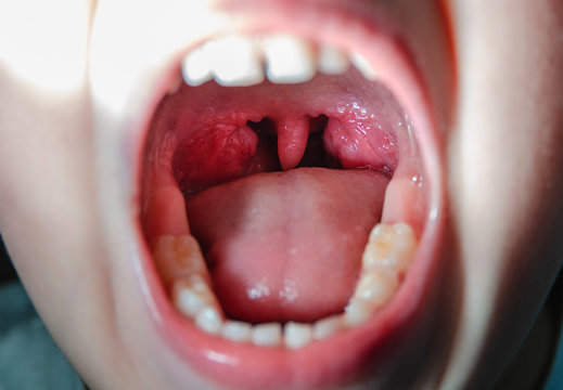 Read more about the article Understanding Pediatric Post Tonsillectomy Dehydration Risk