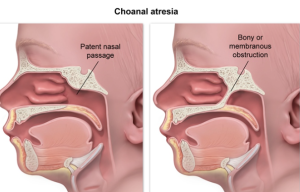 Read more about the article Understanding Pediatric Choanal Stenosis as a Milder Form of Choanal Atresia