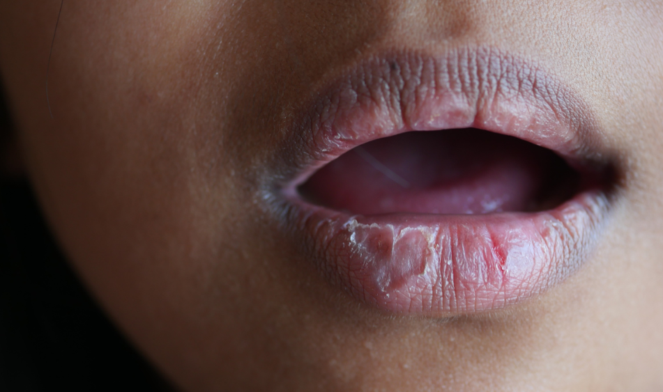 Read more about the article Post Radiation Dry Mouth and Its Long Term Management