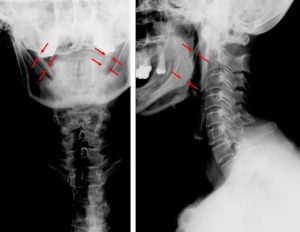 Read more about the article Eagle Syndrome Triggers 5 Alarming Symptoms Mistaken for TMJ