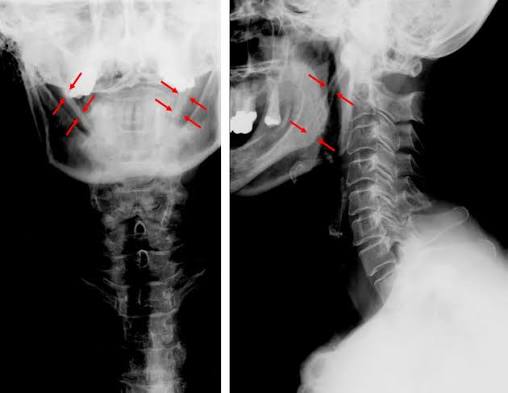 Read more about the article Eagle Syndrome Triggers 5 Alarming Symptoms Mistaken for TMJ