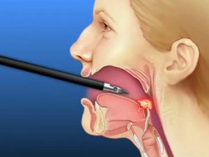 Read more about the article Sleep Apnea After Tonsillectomy Reveals 5 Critical Signs Parents Should Know
